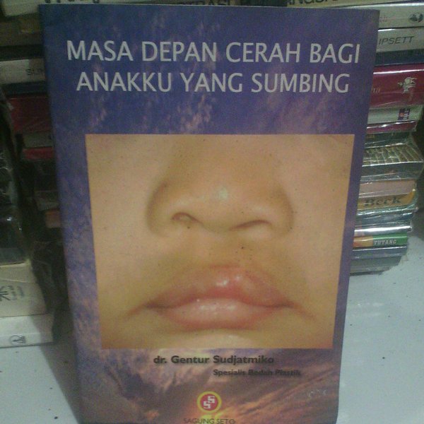 Sampul Masa Depan Cerah Bagi Anakku yang Sumbing / dr. Gentur Sudjatmiko
