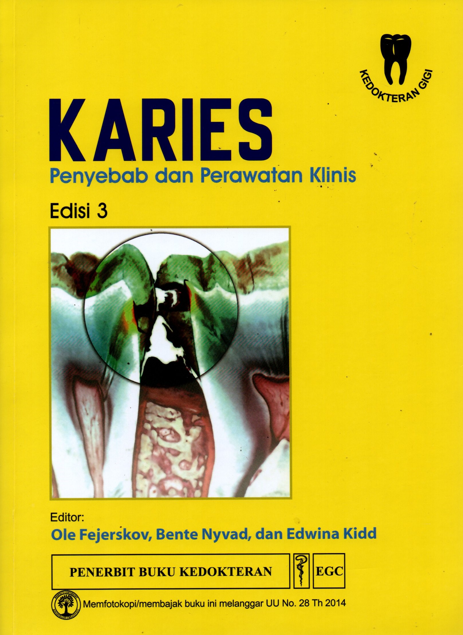 Sampul Karies = Dental Caries :  Penyebab dan Perawatan Klinis = The Disease and Its Clinical Management / Alih Bahasa: Nurani Hayati, Nurmeisari dan Mariska Prihatini